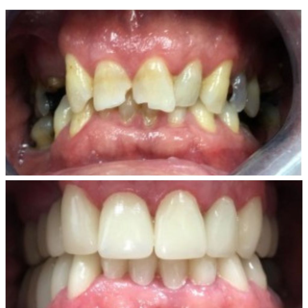 Antes y Despues_Besmile_San Sebastian de los Reyes